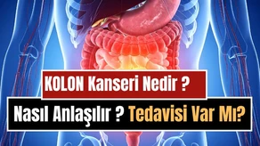 Kolon (Kalın Bağırsak) Kanseri Nedir, Neden Olur, Nasıl Anlaşılır? Belirtileri, Tedavi ve Korunma Yolları