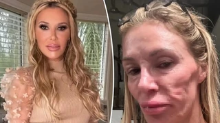Brandi Glanville'in Gizemli Yüz Deformitesine Teşhis Kondu, 130 Bin Dolar Harcad