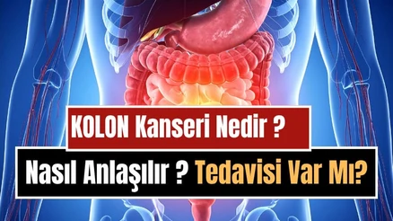 Kolon (Kalın Bağırsak) Kanseri Nedir, Neden Olur, Nasıl Anlaşılır? Belirtileri, Tedavi ve Korunma Yolları