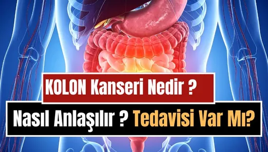 Kolon (Kalın Bağırsak) Kanseri Nedir, Neden Olur, Nasıl Anlaşılır? Belirtileri, Tedavi ve Korunma Yolları