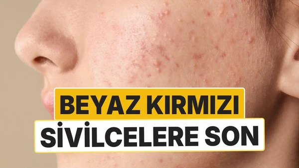 Beyaz ve Kırmızı Sivilcelere Son! 15 Günde Etkili Doğal Cilt Formülü