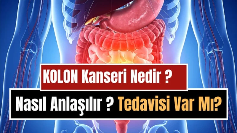 Kolon (Kalın Bağırsak) Kanseri Nedir, Neden Olur, Nasıl Anlaşılır? Belirtileri, Tedavi ve Korunma Yolları