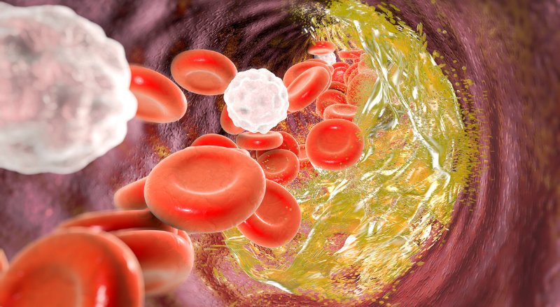 Kolesterol Yüksekliği Nedir, Neden Olur ve Nasıl Düşürülür? Kolesterolü Artıran 15 Besin ve Korunma Yolları - görsel 1