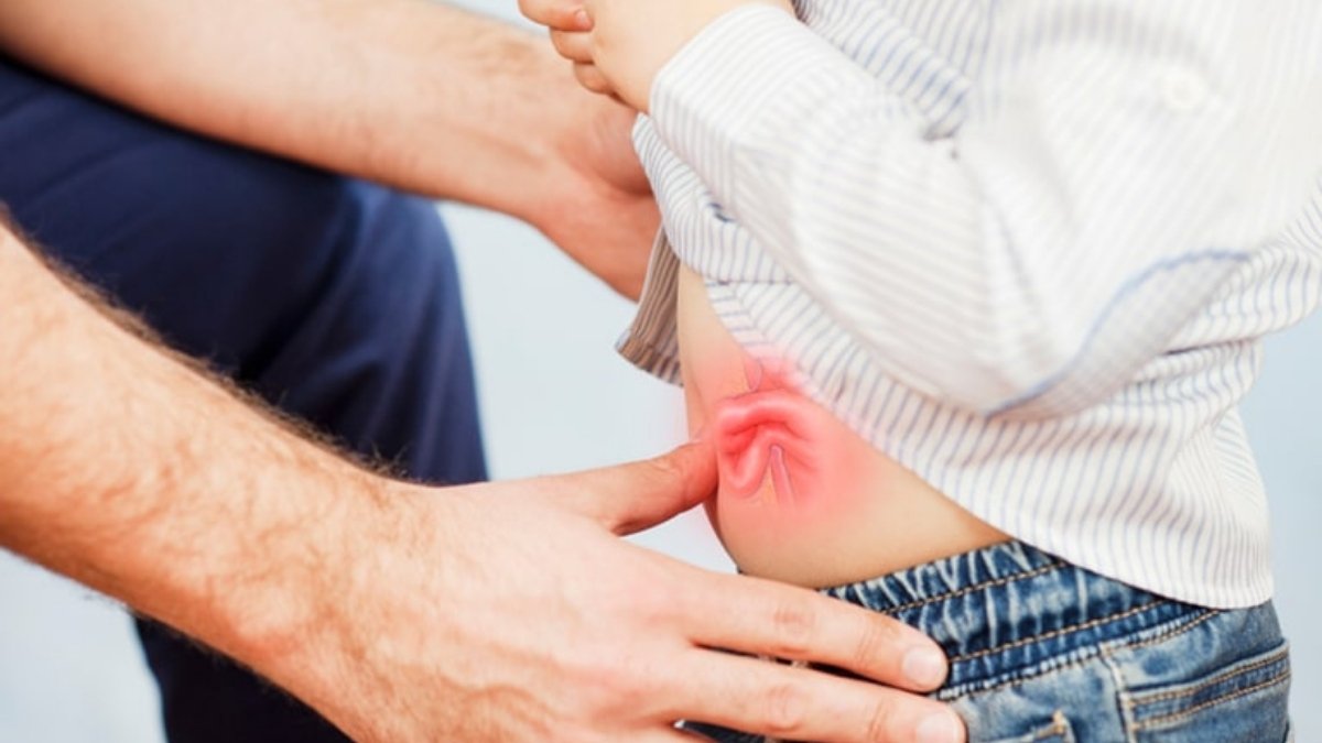 Fıtık (Herni) Nedir? Belirtileri, Türleri ve Tedavi Yöntemleri - görsel 1