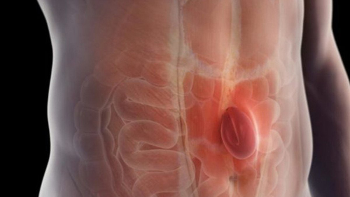 Fıtık (Herni) Nedir? Belirtileri, Türleri ve Tedavi Yöntemleri - görsel 2