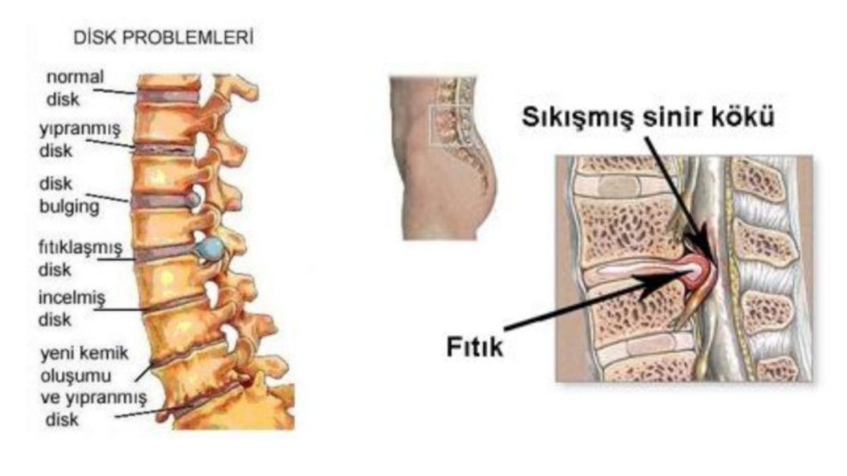 Fıtık (Herni) Nedir? Belirtileri, Türleri ve Tedavi Yöntemleri - görsel 3