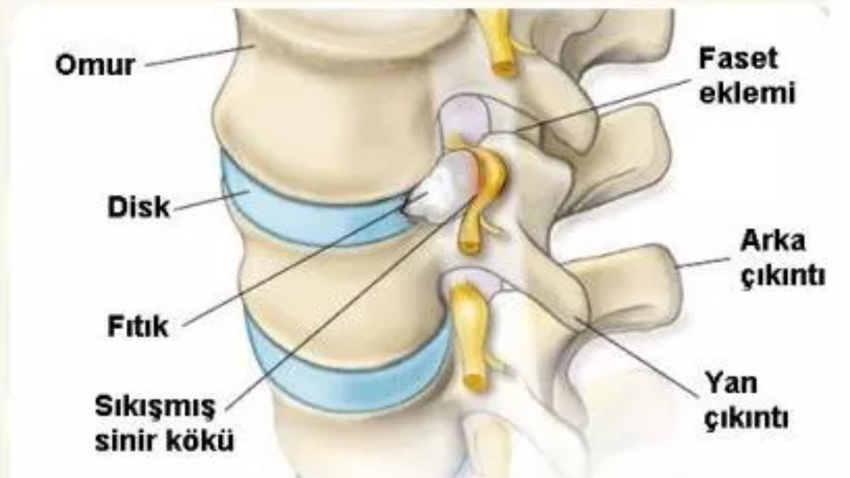 Fıtık (Herni) Nedir? Belirtileri, Türleri ve Tedavi Yöntemleri - görsel 4
