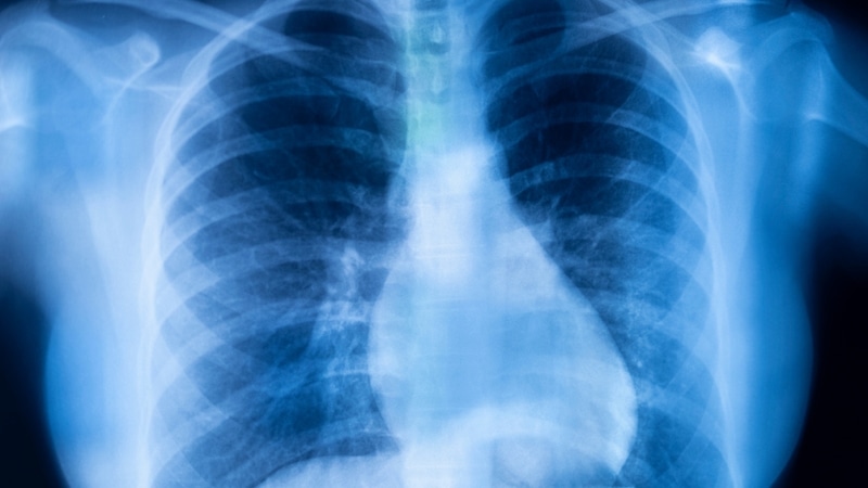 KOAH Her 5 Yetişkinden Birini Tehdit Ediyor: Bu Belirtiler Görmezden Gelinmemeli - görsel 1