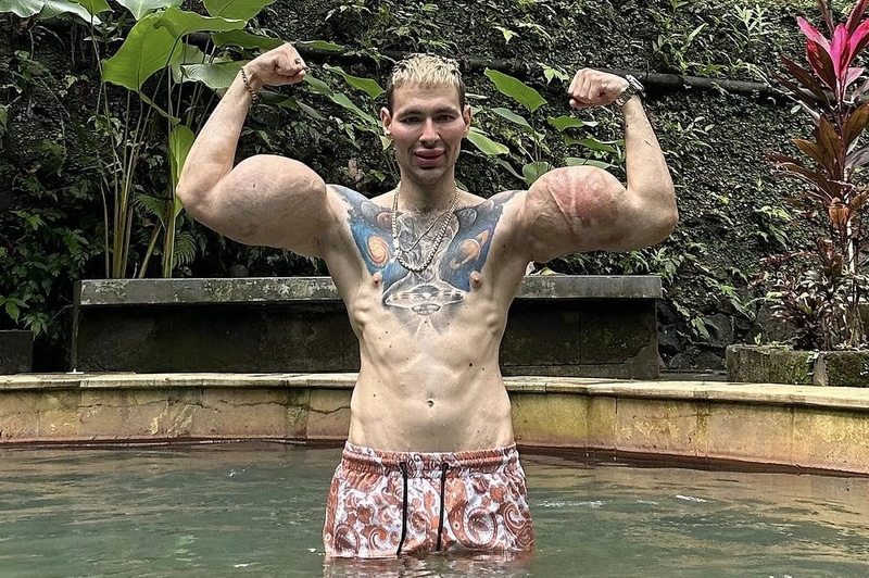 “Rus Temel Reis” Kritik Eşiklerde: Enjekte Ettiği Kimyasallar İki Kolunu Kaybettirebilir - görsel 2