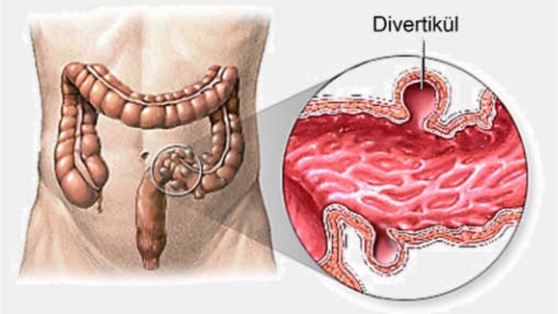 Murat Cemcir Yoğun Bakıma Alındı: İç Kanamanın Nedeni Divertiküler Kanama - görsel 1