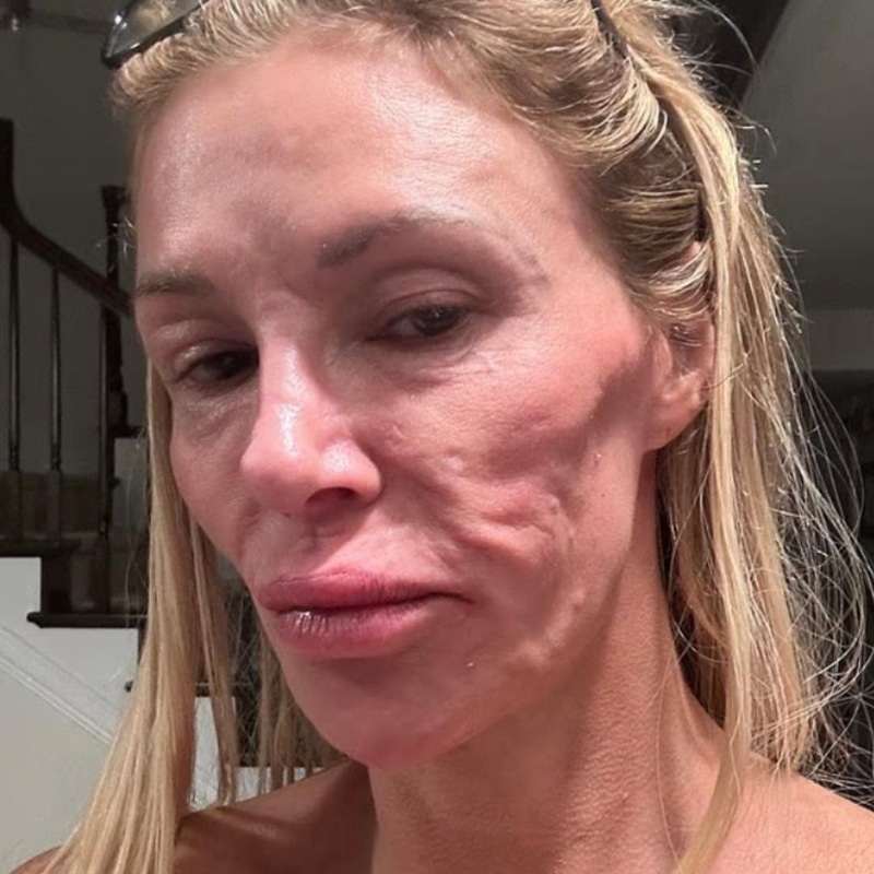 Brandi Glanville'in Gizemli Yüz Deformitesine Teşhis Kondu, 130 Bin Dolar Harcadı - görsel 1