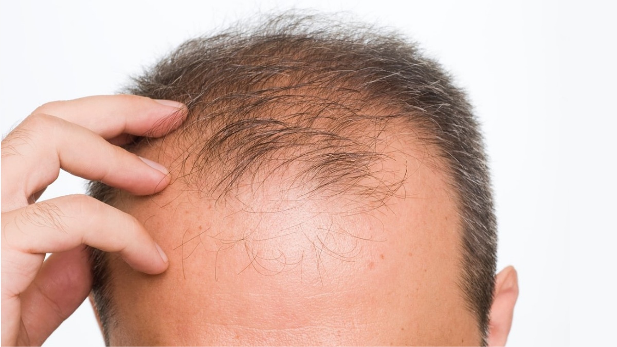 Uzmanlar Uyarıyor: Erkeklerde Saç Dökülmesini En Çok Hızlandıran Alışkanlık - görsel 1