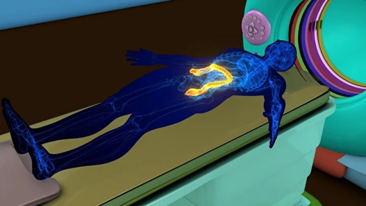 Murat Cemcir’i Yoğun Bakıma Götüren Sinsi Tehlike: Divertikül Kanaması Uyarısı - görsel 2