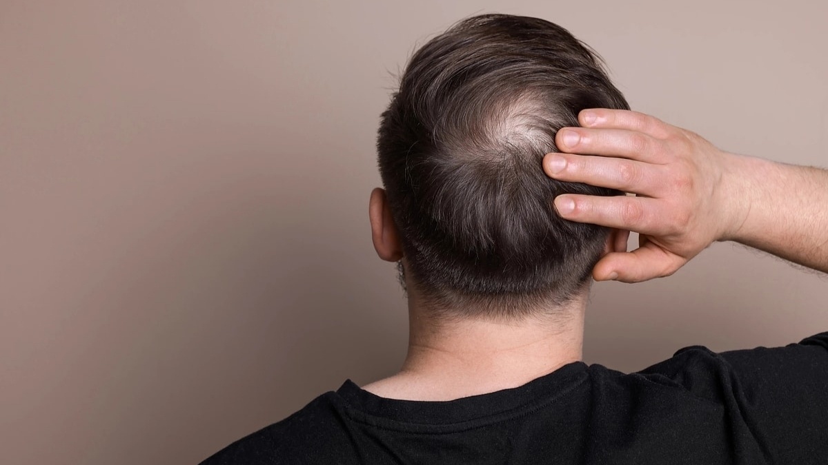 Erkek Tipi Kellik İçin Tarihi Gelişme: Clascoterone Tedavisinde Faz III Sonuçları Aşıyor - görsel 1